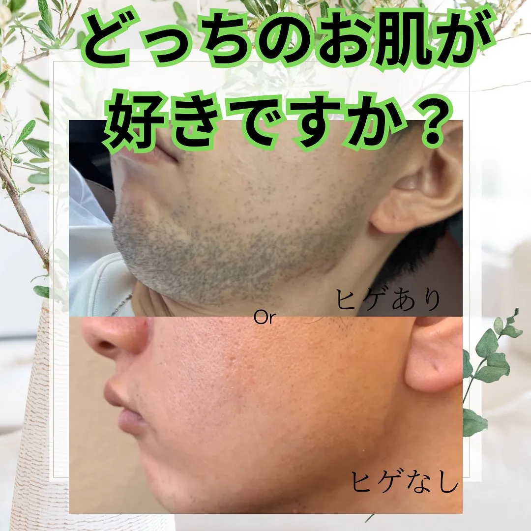 ヒゲ脱毛したいorしたくない？